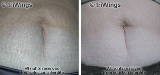 Vergetures du ventre après traitement par Triwings